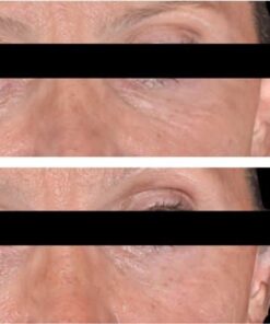 cebelia t10 eye lift 3