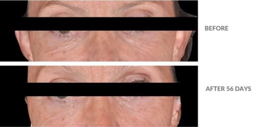 cebelia t10 eye lift 3